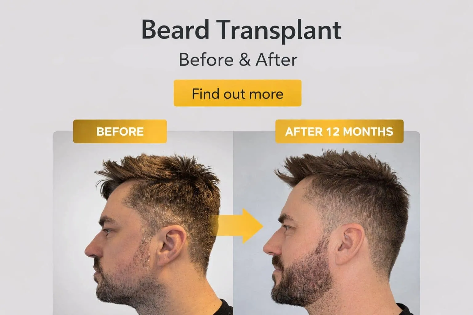 Harley Street Hair Transplant Clinics London Home Page Beard Transplants