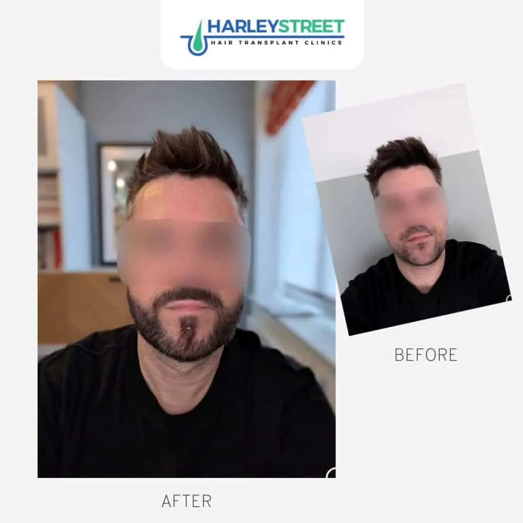 Beard Transplant in Manchester Beard transplant before and after Paul