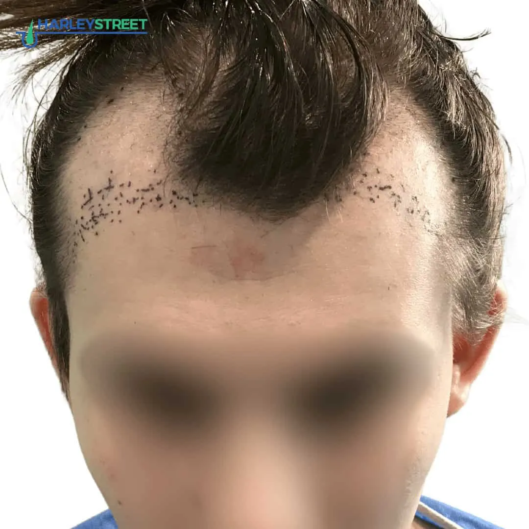 What Is a Receding Hairline? Causes, Signs and Treatment Charlotte Lloyd pre surgery