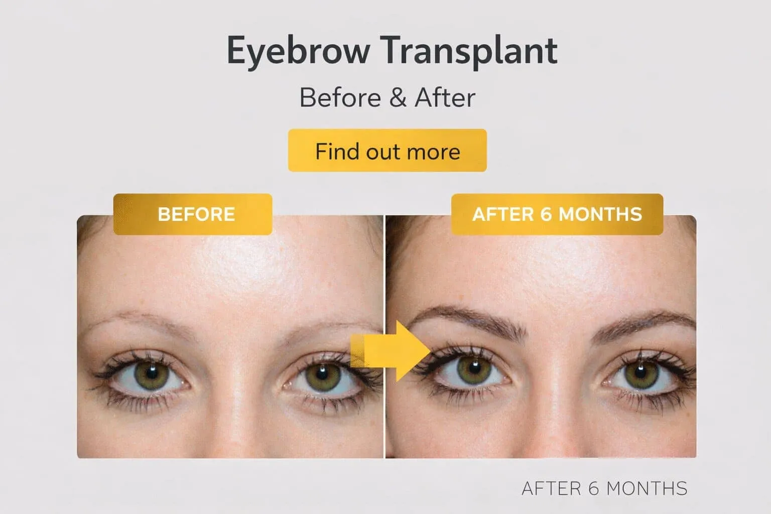 Harley Street Hair Transplant Clinics London Home Page Eyebrow Transplants