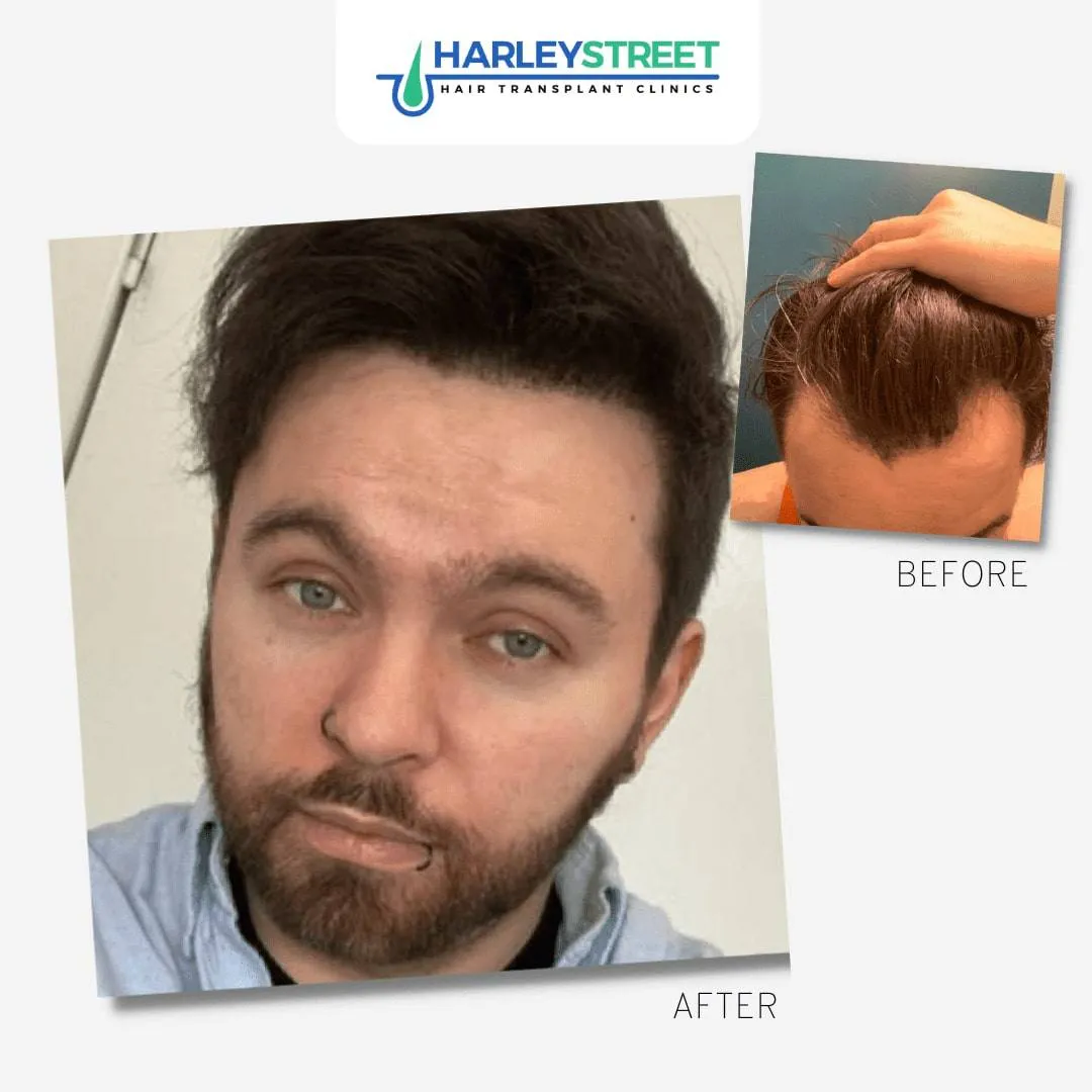 Hair Transplant Before and After Results FUE-Before-and-After-3
