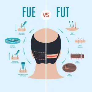FUE Hair Transplant FUE vs FUT in hair transplant methods min