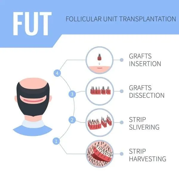 Beard Transplant in Manchester FUT hair extraction method
