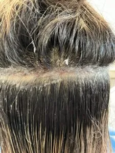 FUT Hair Transplant FUT hair transplant donor area