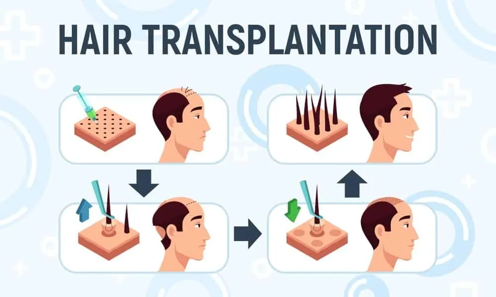 Hair Transplantation statistics