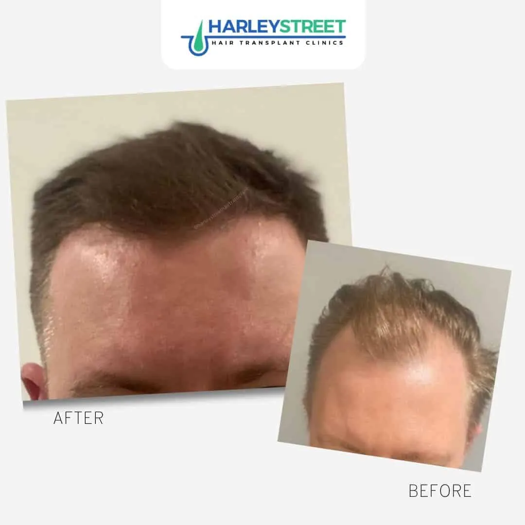Hair Transplant Before and After Results Harley St before and after front hairline and temples