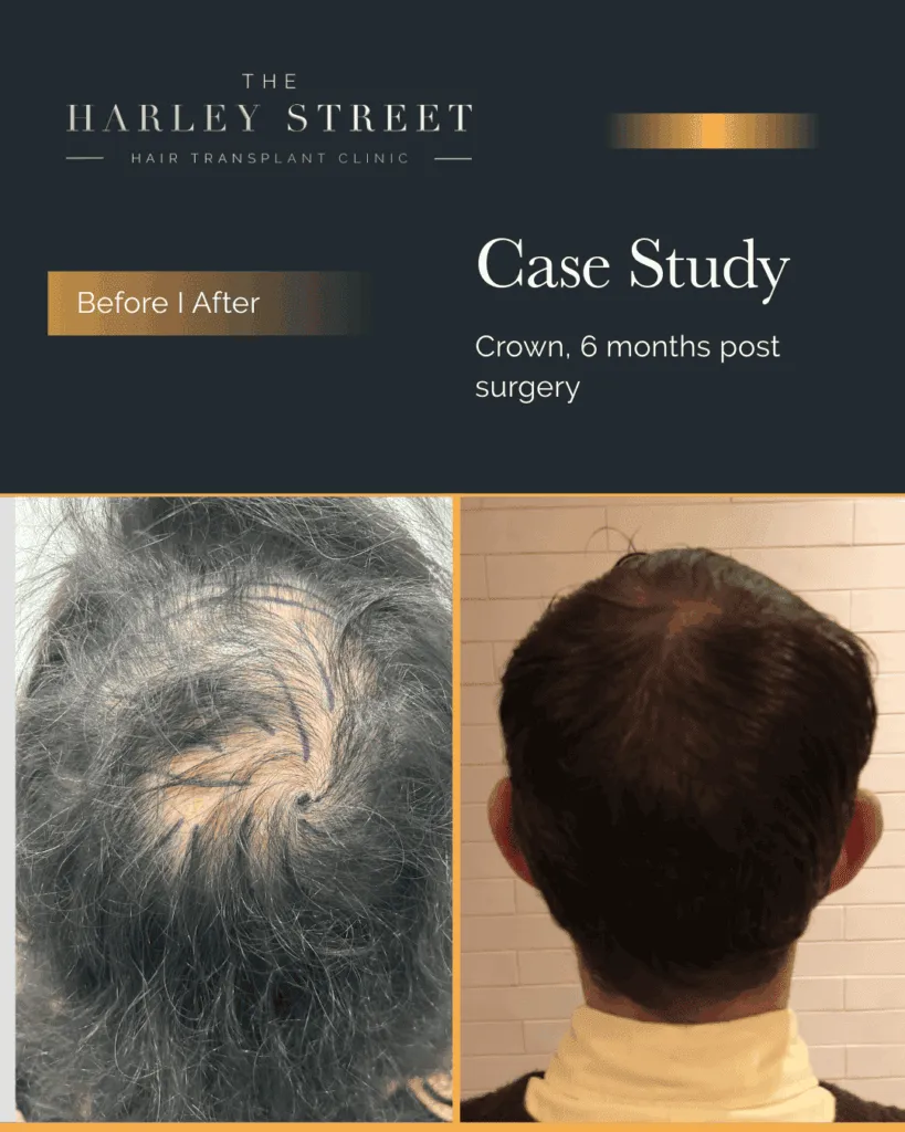 FUT Hair Transplant Harley Street HT Patient, Arturo, crown