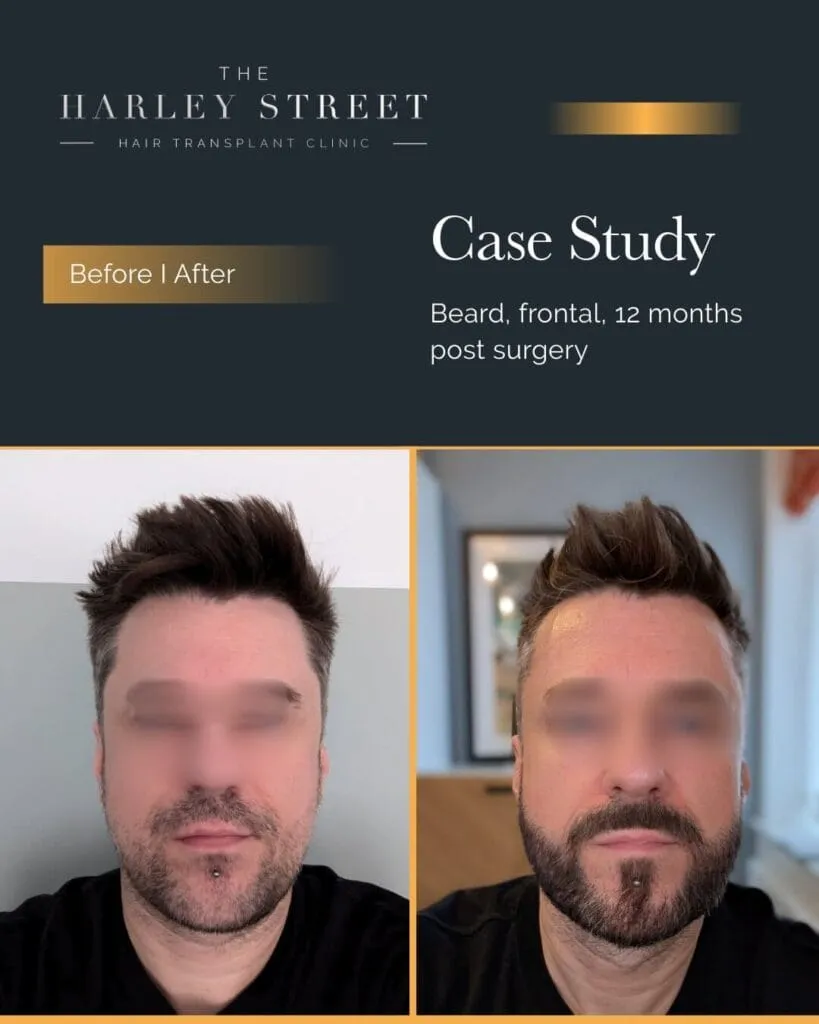 Beard Transplant in Manchester Harley Street HT Patient Beard - P Burley frontal