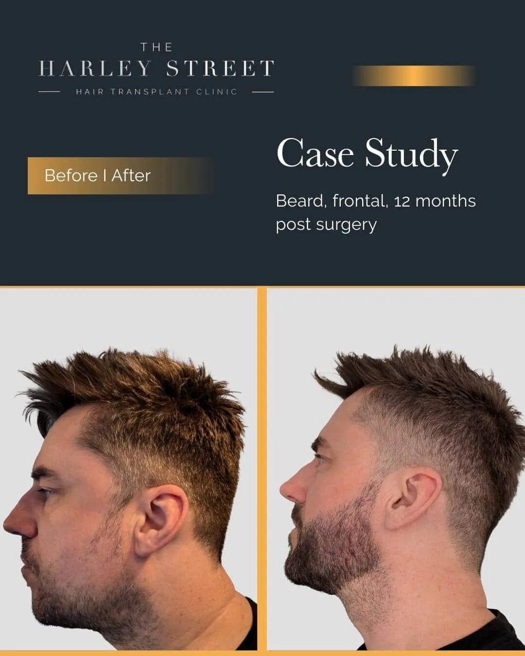 Hair Transplant Before and After Results Harley Street HT Patient Beard - P Burley side