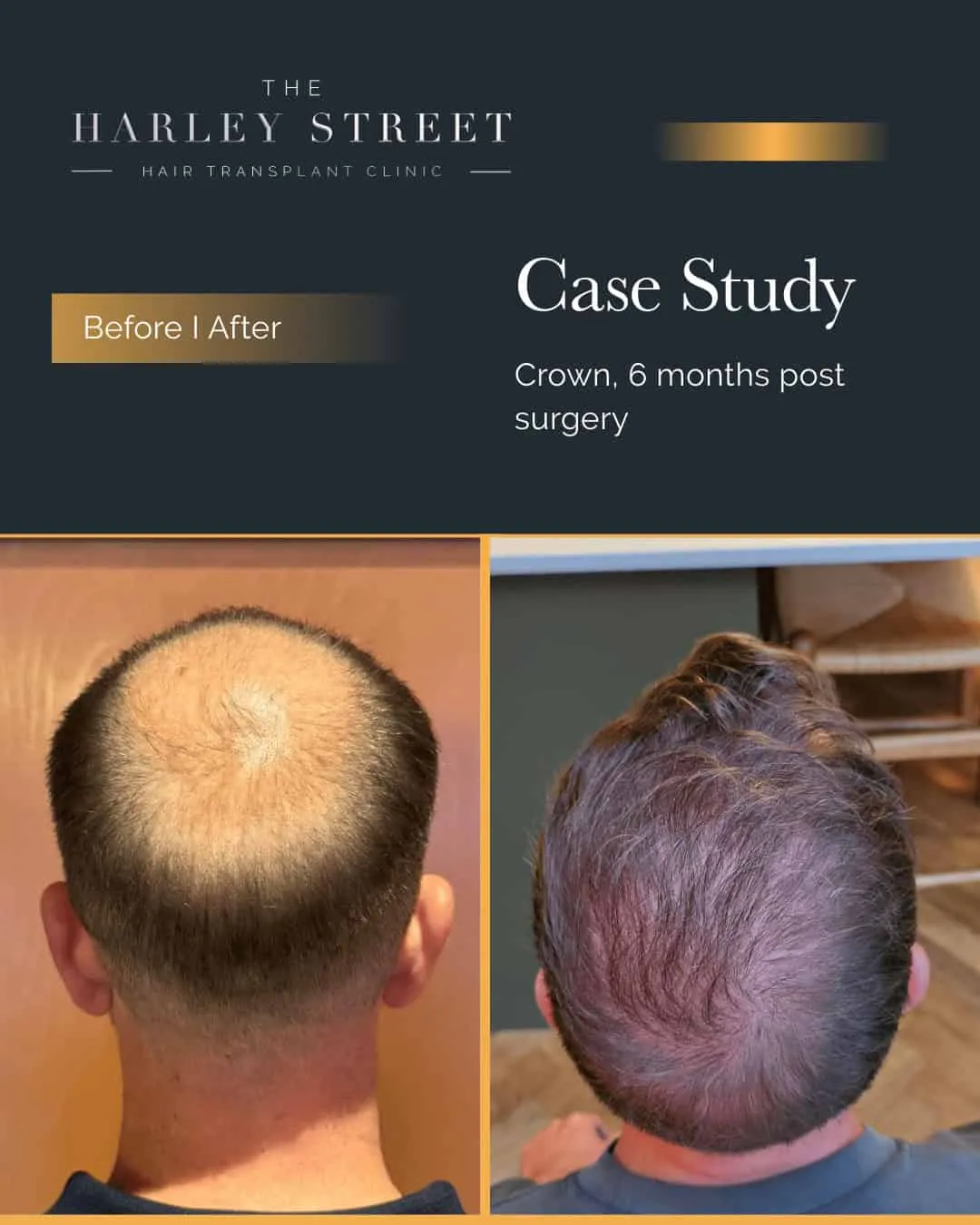 Crown Hair Transplant Harley Street HT clinics pt, AS crown large