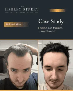Hairline Hair Transplant Harley Street HT patient, Elliot hairline