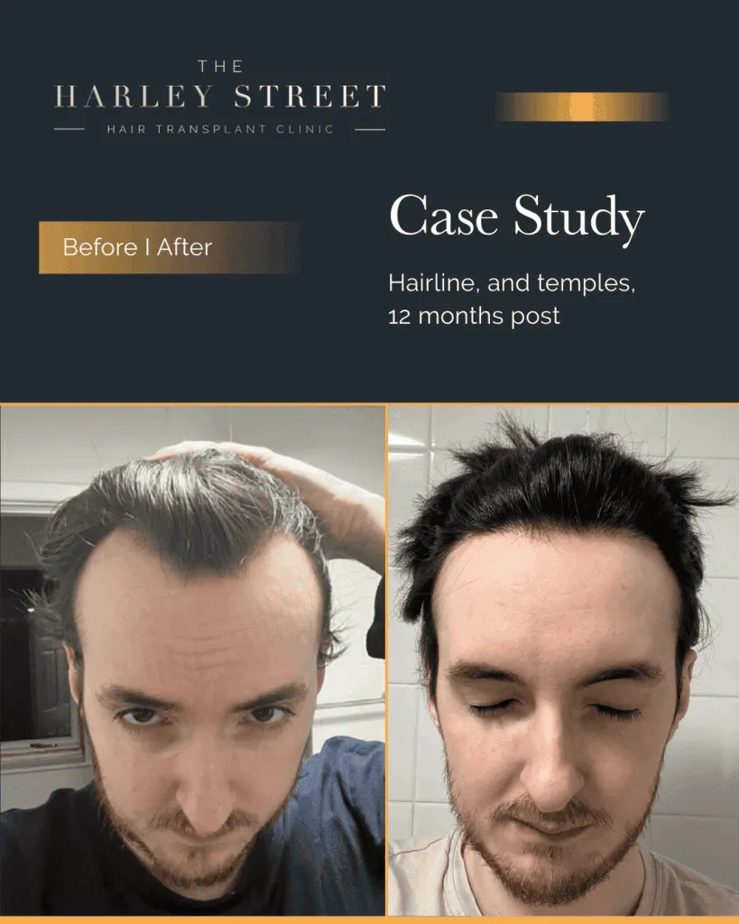 FUT Hair Transplant Harley Street HT patient, Elliot hairline