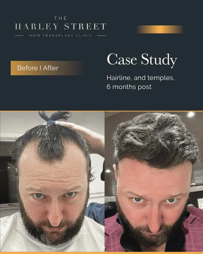 FUT Hair Transplant Harley Street HT pt Gerard Walsh hairline