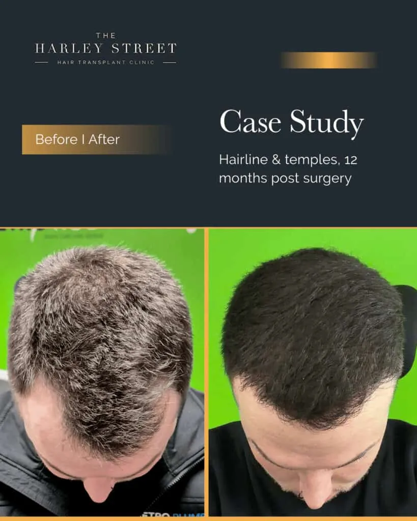 FUT Hair Transplant Harley Street HT pt Gill hairline