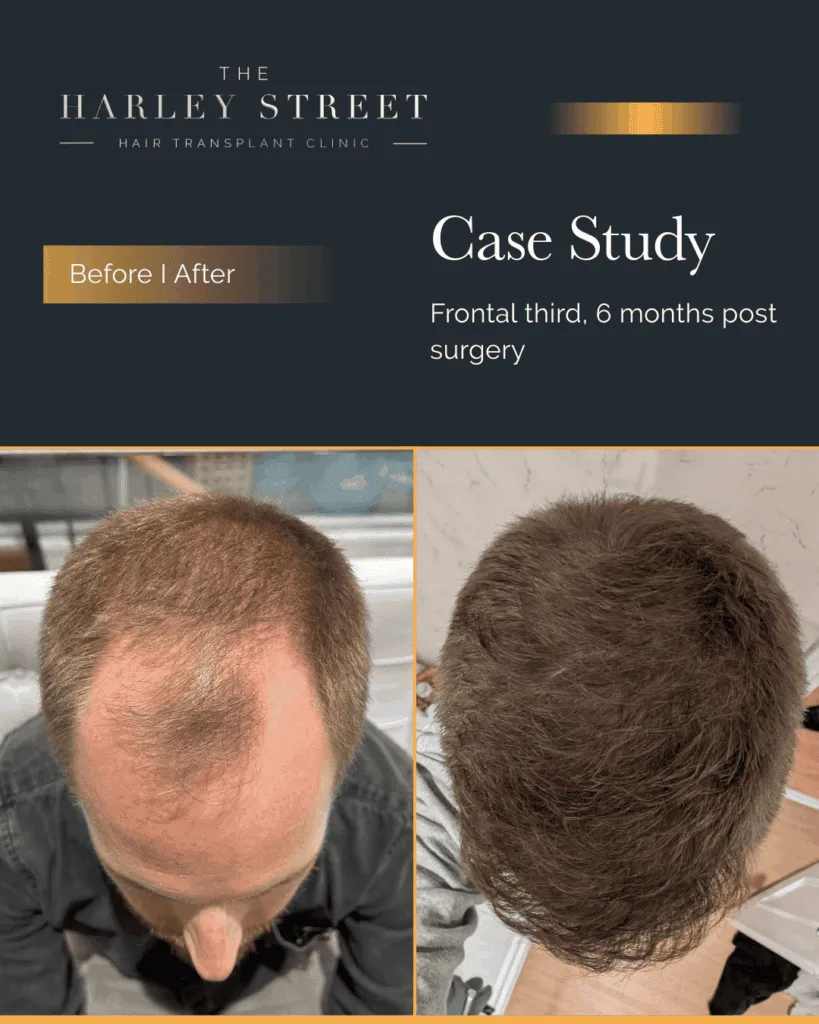 FUT Hair Transplant Harley Street HT pt Hughes, hairline aerial view