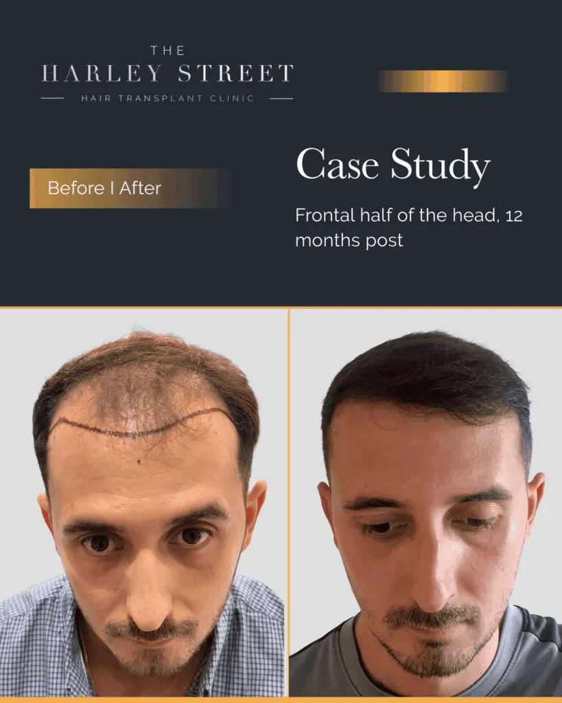FUT Hair Transplant Harley Street HT pt Ilir frontal 3rd