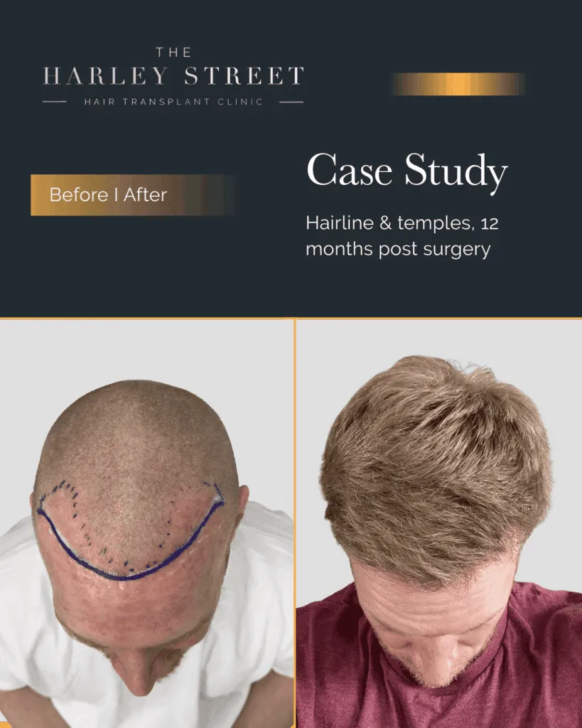 FUT Hair Transplant Harley Street HT pt Kirkpatrick hairline aerial