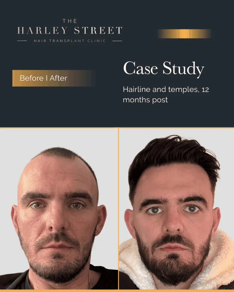 FUT Hair Transplant Harley Street HT pt Ryan frontal 3rd hairline