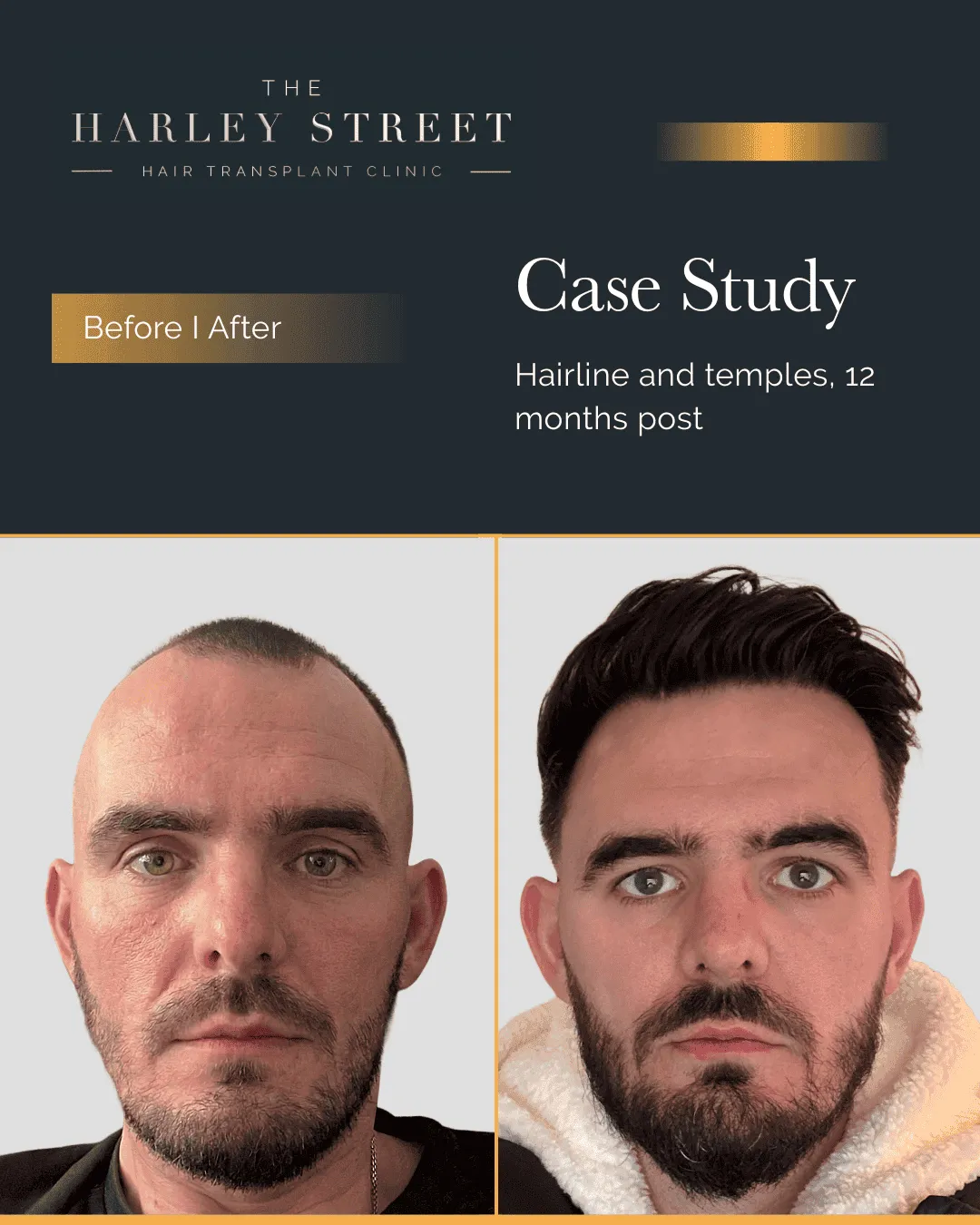 Hair Transplant Cost Harley Street HT pt Ryan frontal 3rd hairline