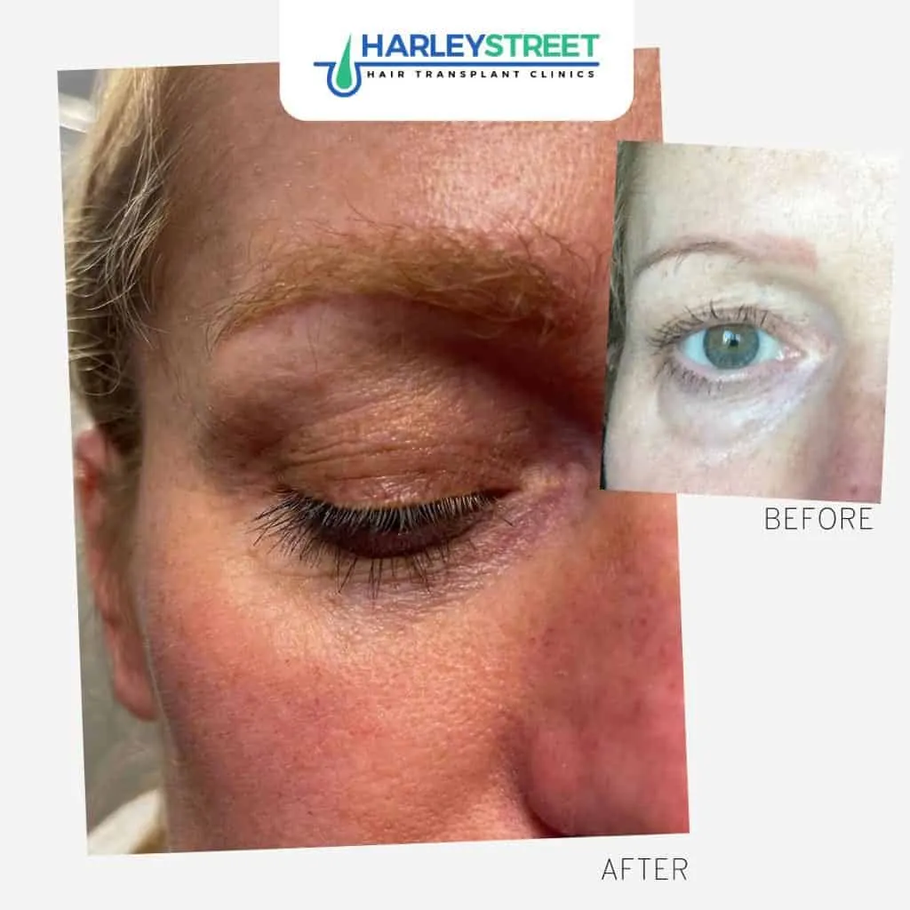 Eyebrow Transplants Harley Street Hair Transplant Clinics female patient eyebrow transplant before and after