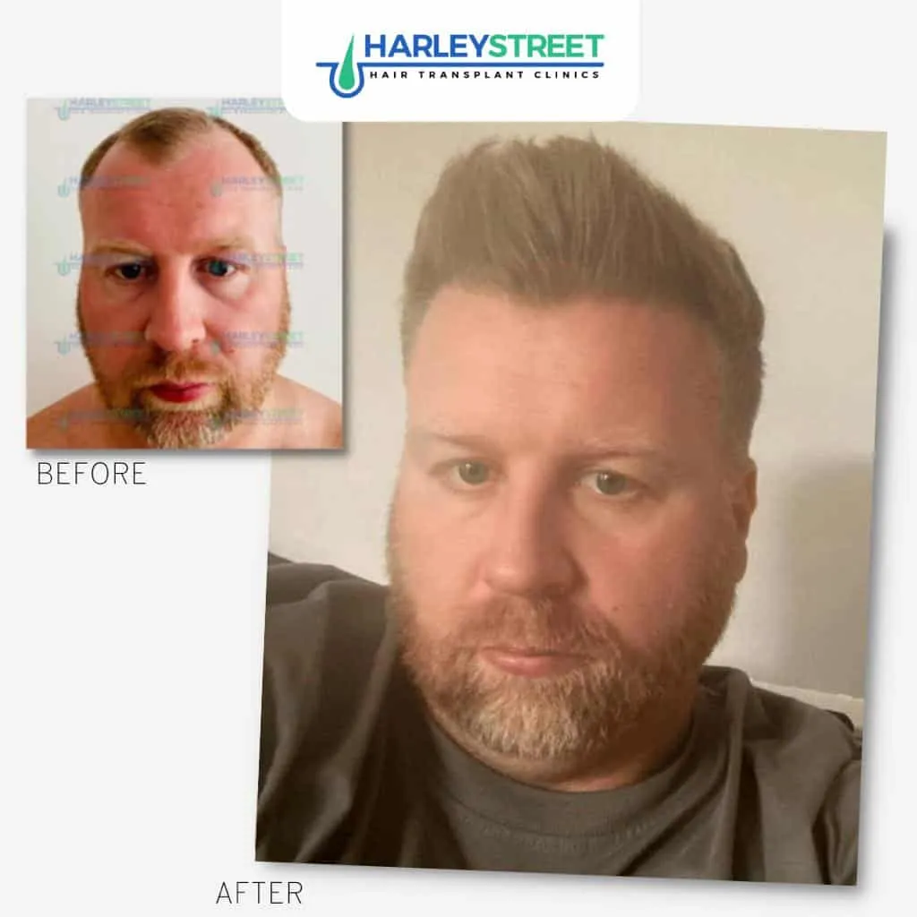 Hair Transplant Before and After Results Harley Street Hair Transplant Clinics patient Aaron before and after