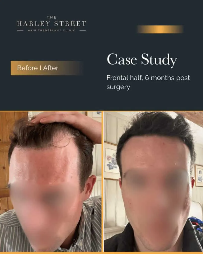 FUT Hair Transplant Harley Street pt Finney hairline