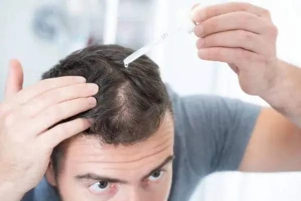 Man applying topical finasteride and minoxidil combo
