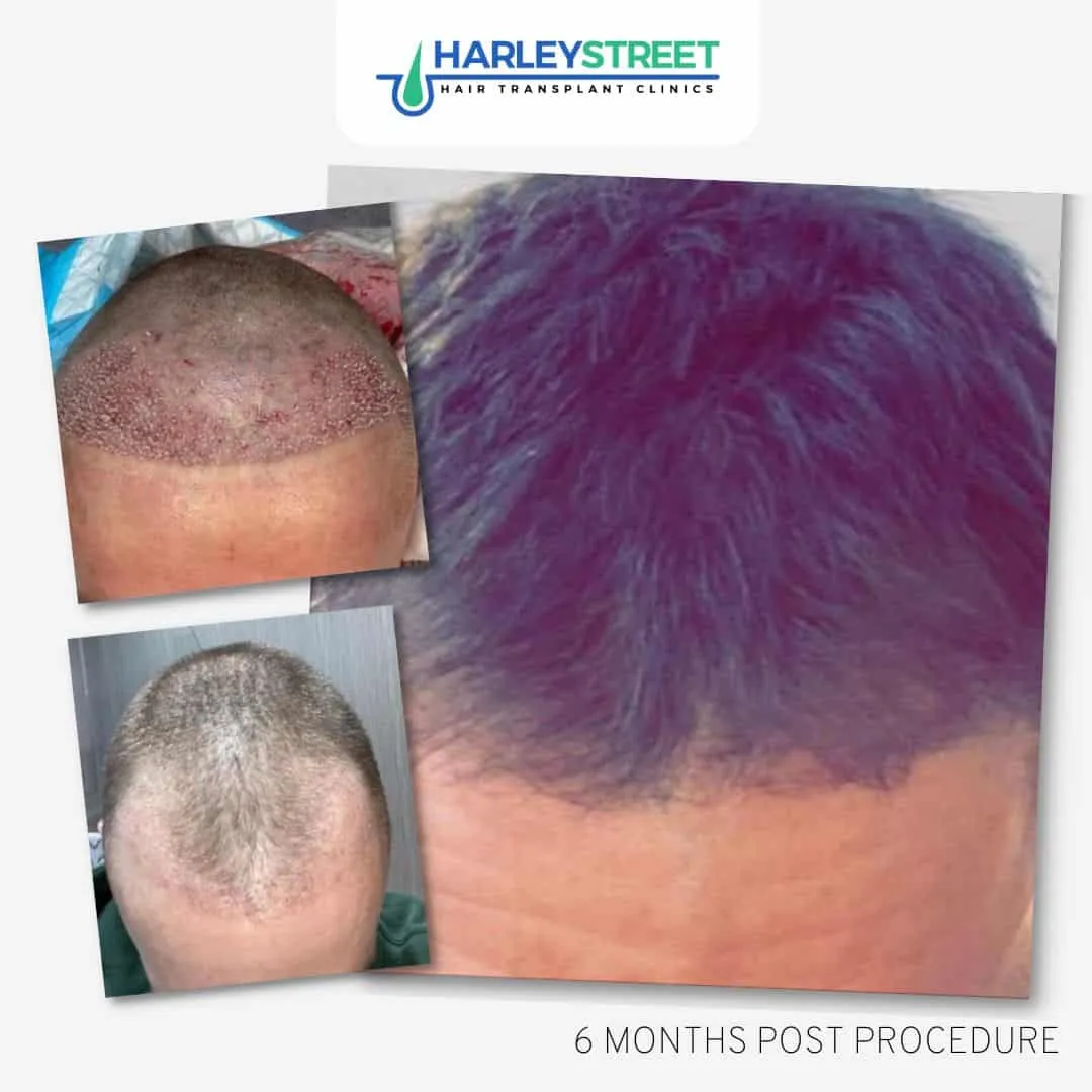 Hair Transplant Before and After Results Mark 6 months post procedure 2000 grafts