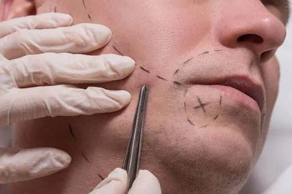 beard transplant side effects
