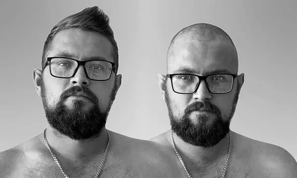 body hair transplant for men