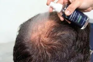 How to Apply a Topical Finasteride and Minoxidil Combination Spray combination spray being sprayed on thinning crown
