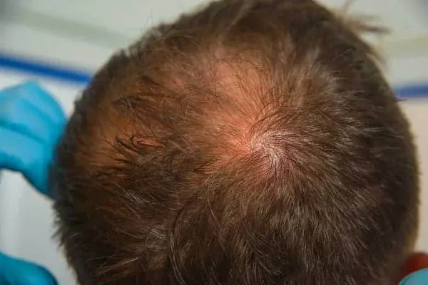 Crown Hair Transplant crown hair loss
