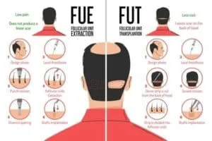 Hair Transplant Statistics fue vs fut hair transplant