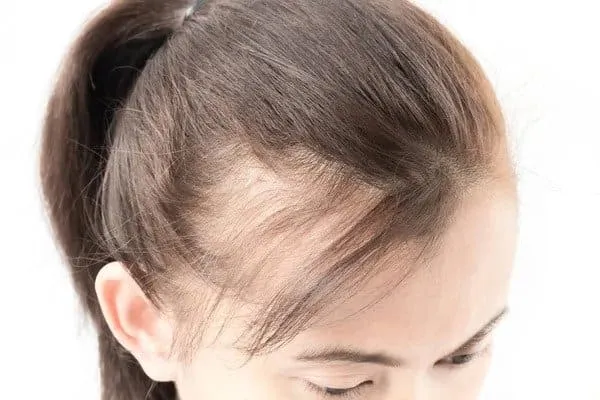 Illnesses That Cause Hair Loss in Women illnesses that cause hair loss in women