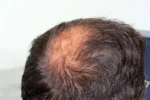 How to Apply a Topical Finasteride and Minoxidil Combination Spray man with dry and clean scalp with crown thinning