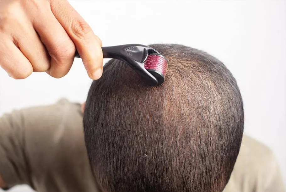 Microneedling For Hair Loss: Does It Actually Work? microneedling for hair loss