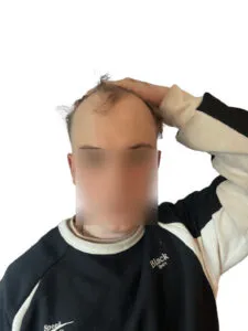 What Is a Receding Hairline? Causes, Signs and Treatment patient with receding hairline