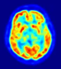 Addicted brain