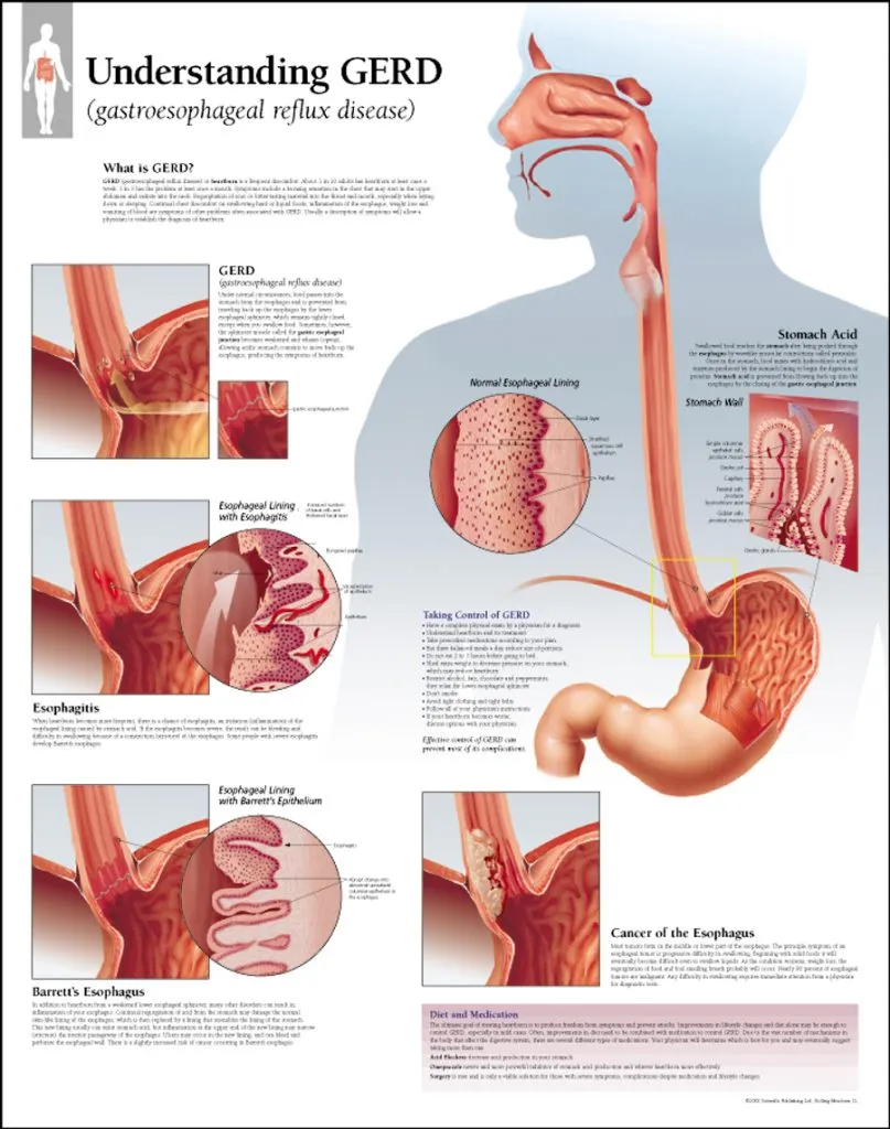 What Is Gastroesophageal Reflux Disease (GERD)?