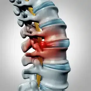 herniated disk treatment in houston