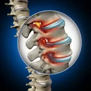 spinal stenosis treatment in houston
