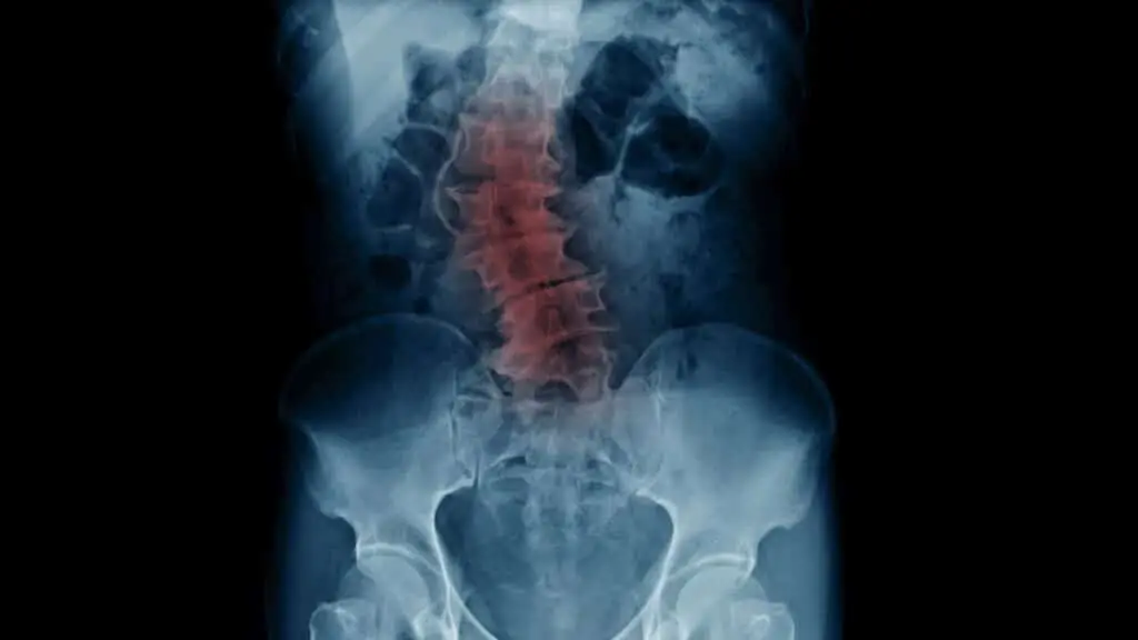 Scoliosis surgery