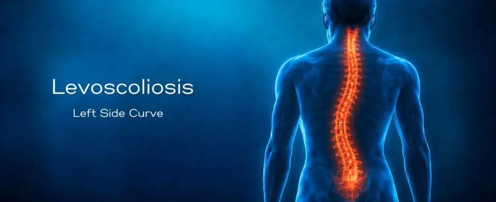 What is Levoscoliosis