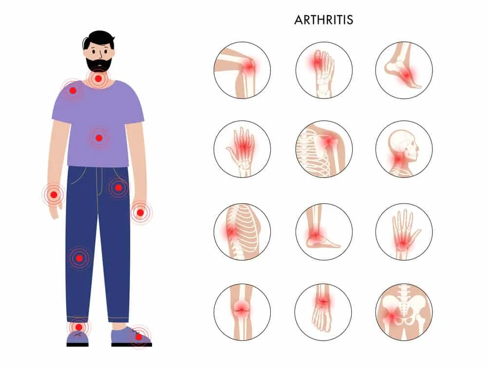 Arthtritis illustration- TeleLeaf