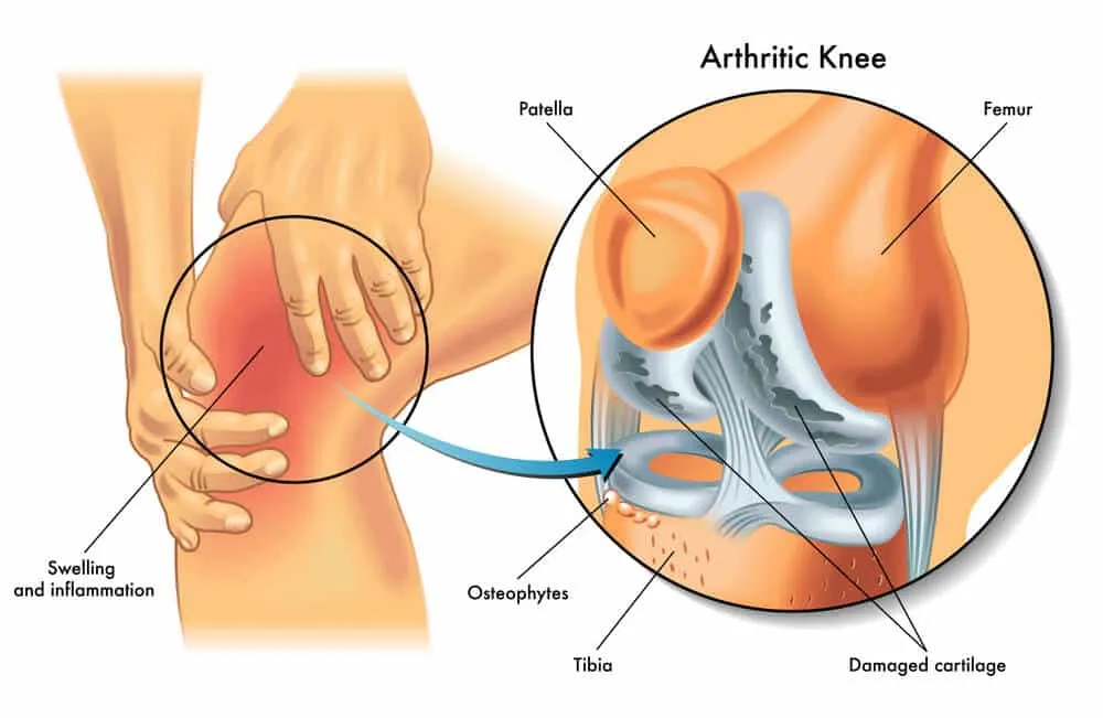 MMJ for Arthritis-TeleLeaf