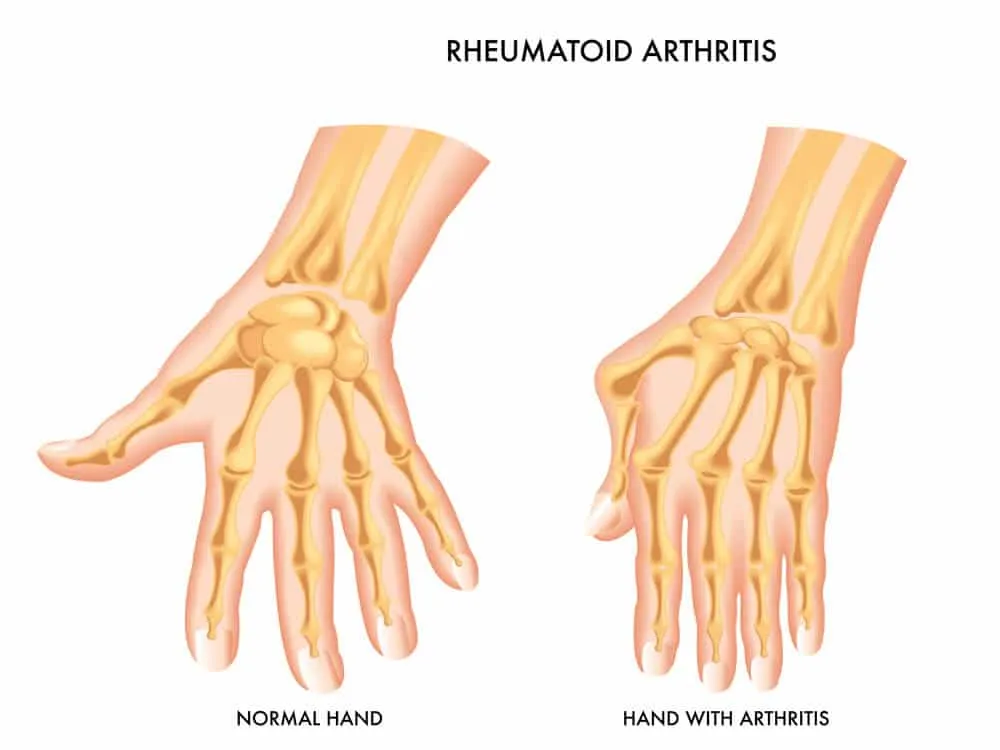 Rheuma Arthritis-TeleLeaf.com