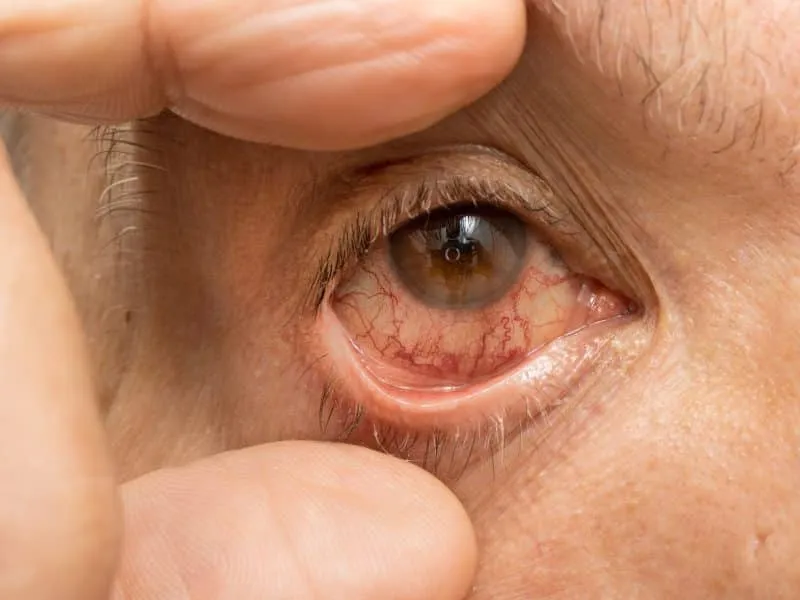 Man with a pink eye infection in one of his eyes