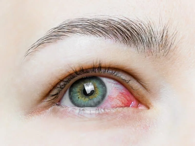 Close up of a severe bloodshot red eye. Viral Blepharitis, Conjunctivitis, Adenoviruses. Irritated or infected eye