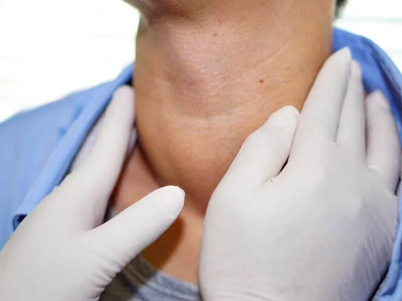 Asian lady woman patient have abnormal enlargement of thyroid gland Hyperthyroidism at throat.
