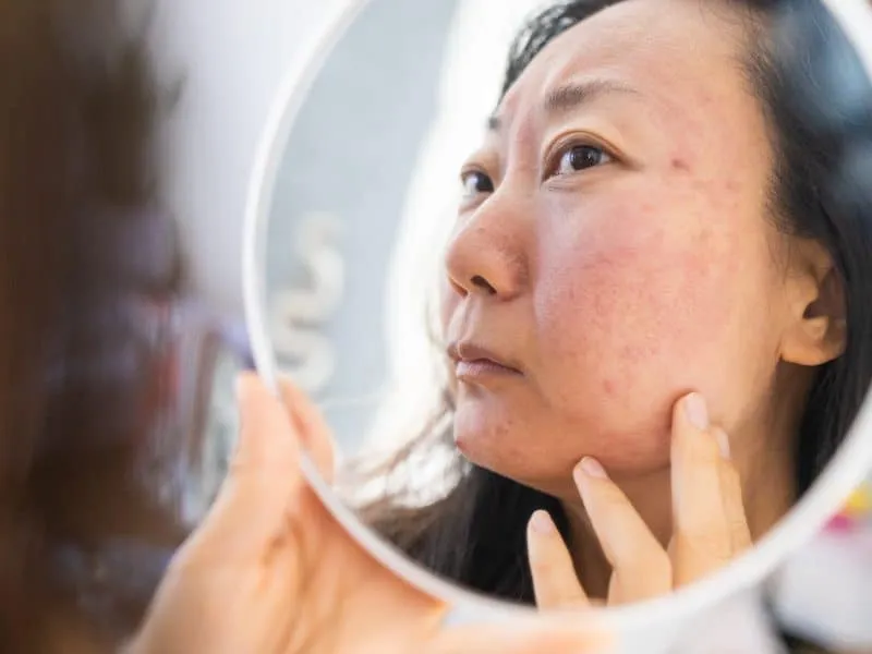 dermatology-puberty-asian-young-woman-girl-looki-2025-03-13-00-24-50-utc